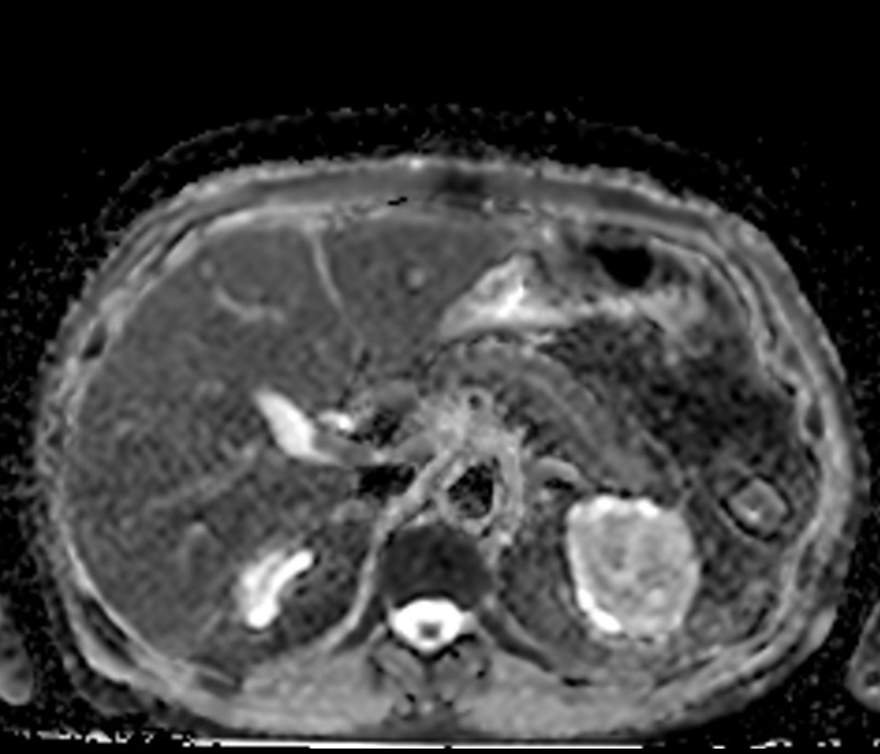 ADC map pancreas DWI