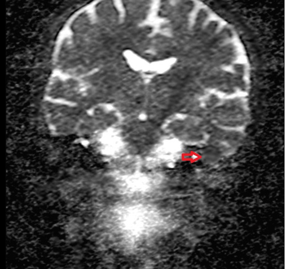 ADC map showing cholesteatoma