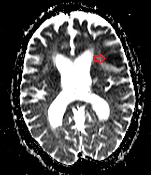 ADC map showing stroke