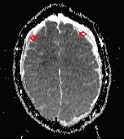 ADC map showing subdural hematoma