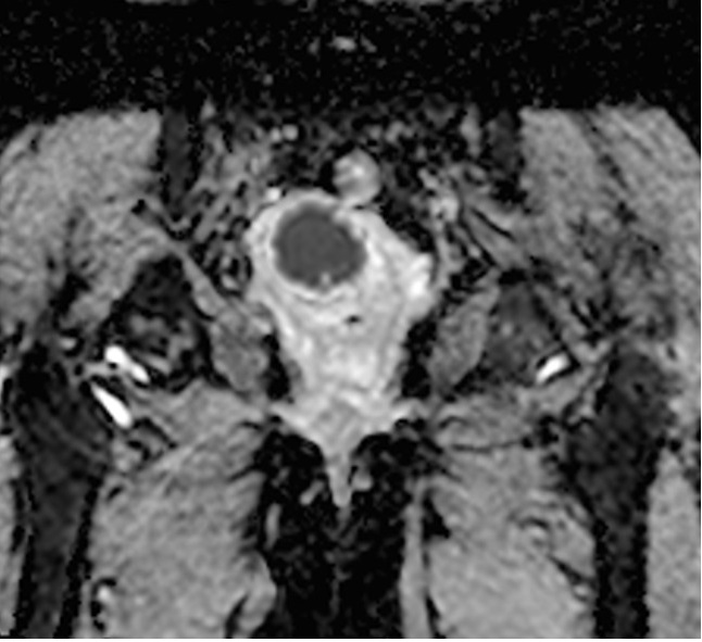 ADC map shows cervical cancer