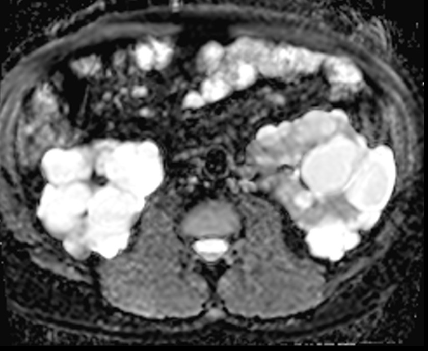 ADC map shows polycystic kidney