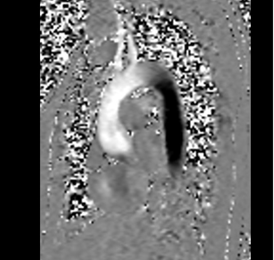 Aortic in plane flow is measured with a VENC of 160