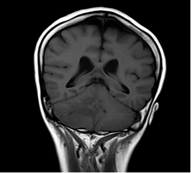 Brain scan with out Gadolinium DTPA enhancement