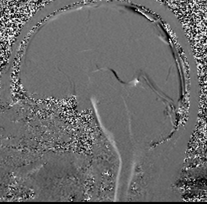 CSF flow is measured with a VENC of 6