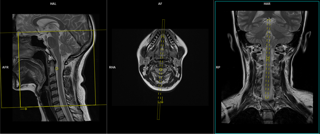 CSF flow study Chiari I malformation protocol and planning
