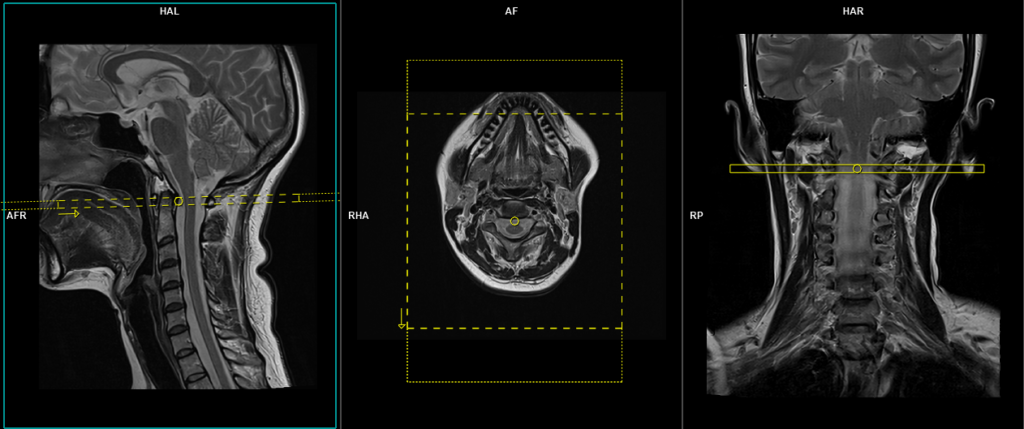 CSF flow study Chiari I malformation protocol and planning of axial scans
