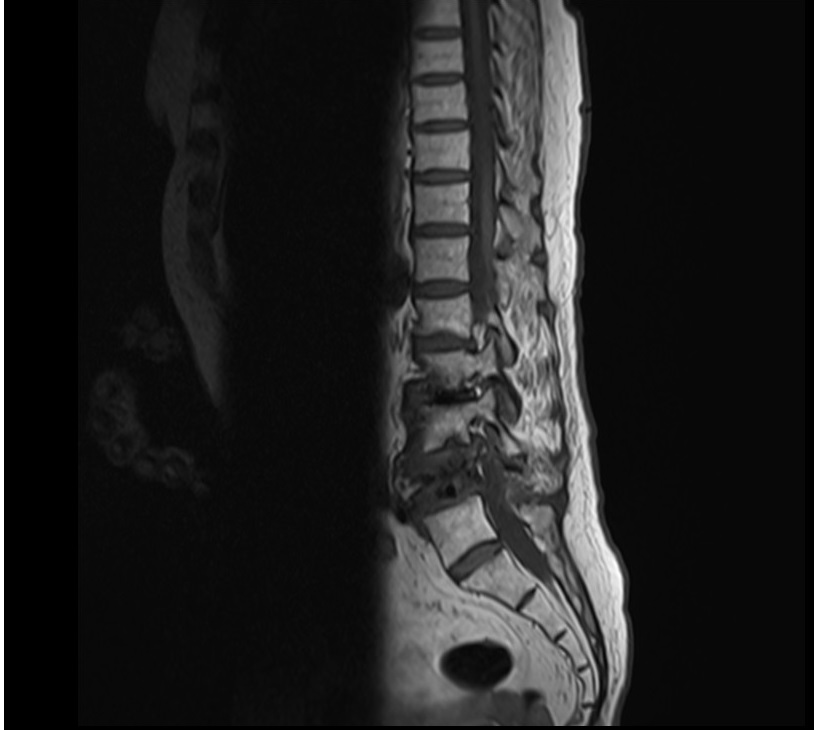 Image Shows No Distortion Artifact When Patient Is Positioned at Iso Center