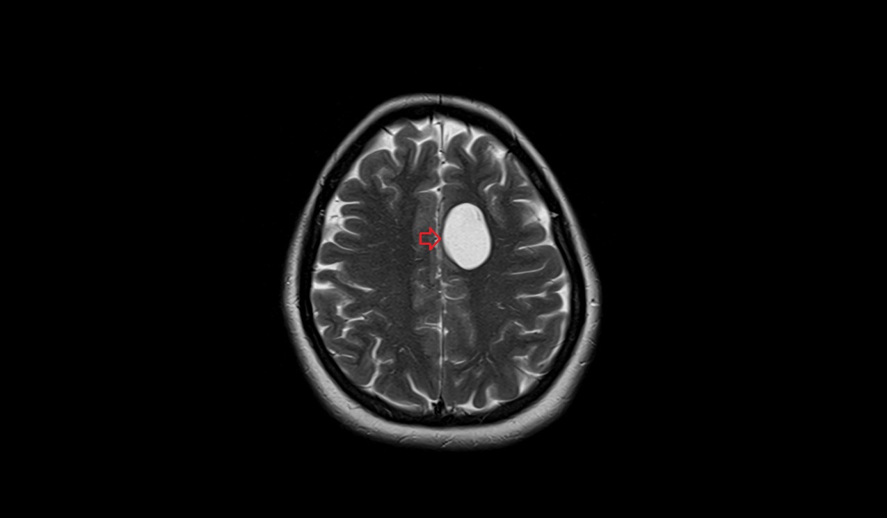Neuroglial Cysts (Glioependymal Cysts, Neuroepithelial Cysts) MRI