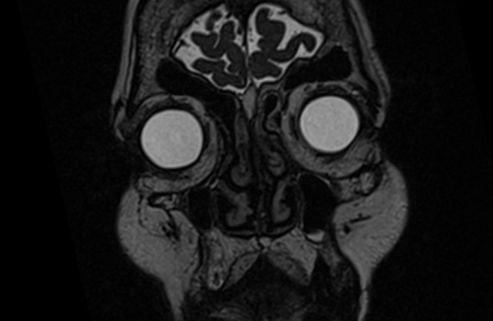 MRI cisternography (csf rhinorrhea) 3D space coronal image 2