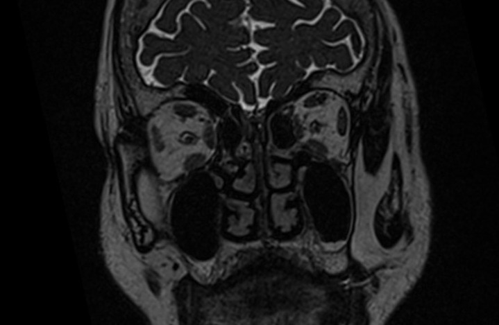 MRI cisternography (csf rhinorrhea) 3D space coronal image 5