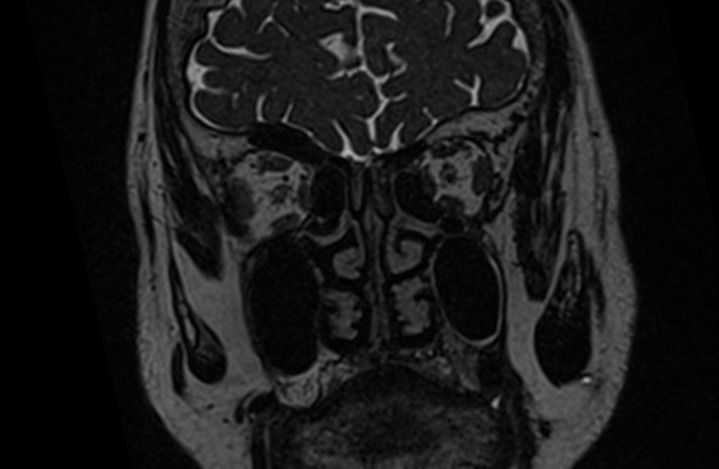 MRI cisternography (csf rhinorrhea) 3D space coronal image 6