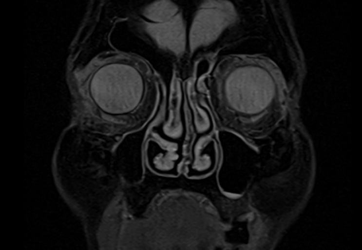 MRI cisternography (csf rhinorrhea) STIR coronal image 1