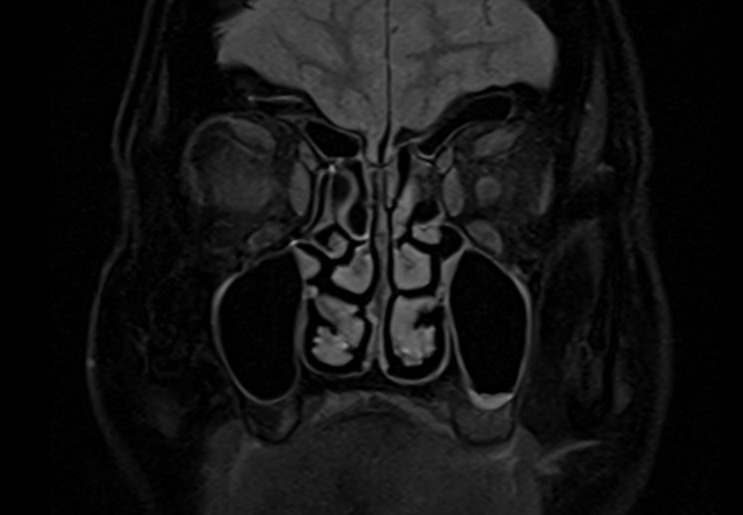 MRI cisternography (csf rhinorrhea) STIR coronal image 2
