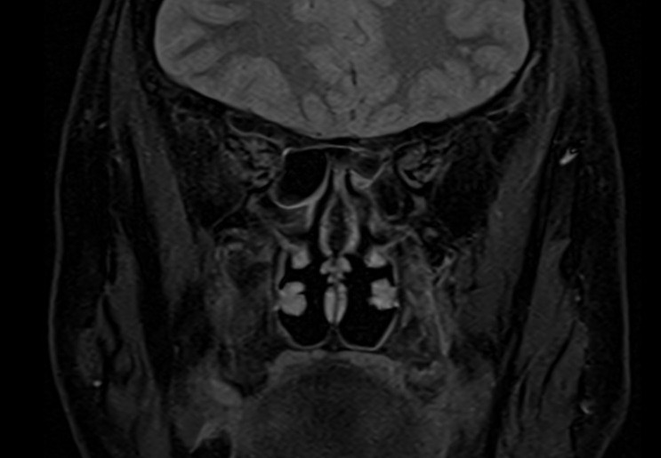 MRI cisternography (csf rhinorrhea) STIR coronal image 4