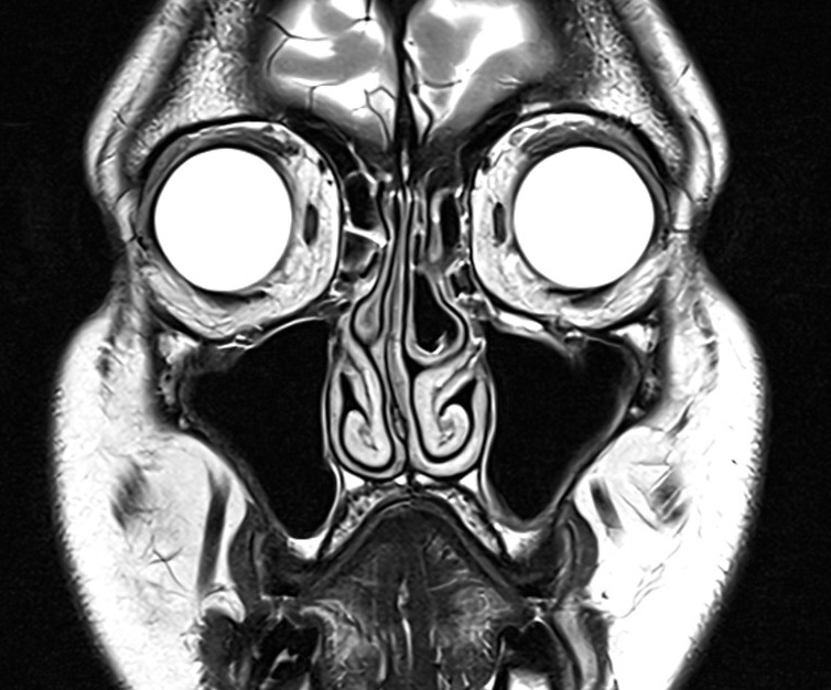 MRI cisternography (csf rhinorrhea) T2 coronal image 3