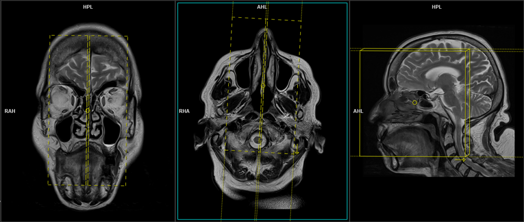 MRI cisternography (csf rhinorrhea) planning and protocol of Sagittal T2 sequence