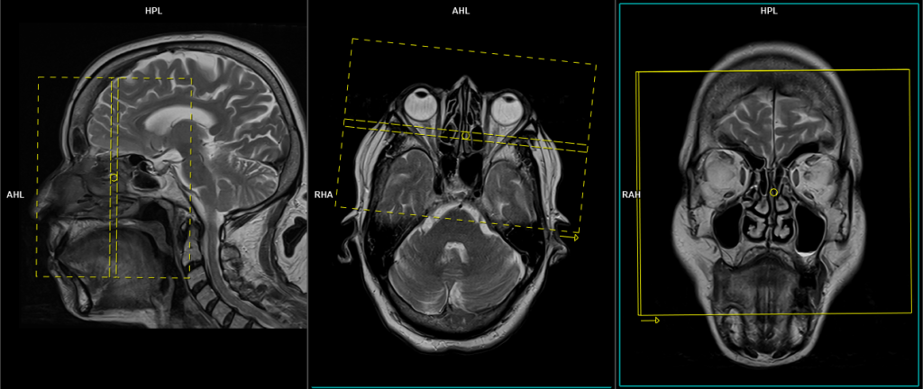 MRI cisternography (csf rhinorrhea) planning and protocol of coronal STIR sequence