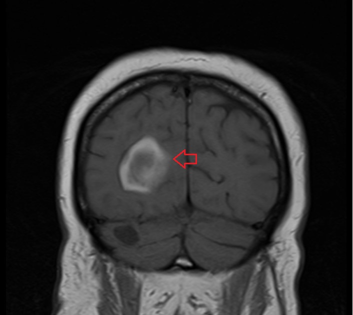 MRI late subacute haemorrhage