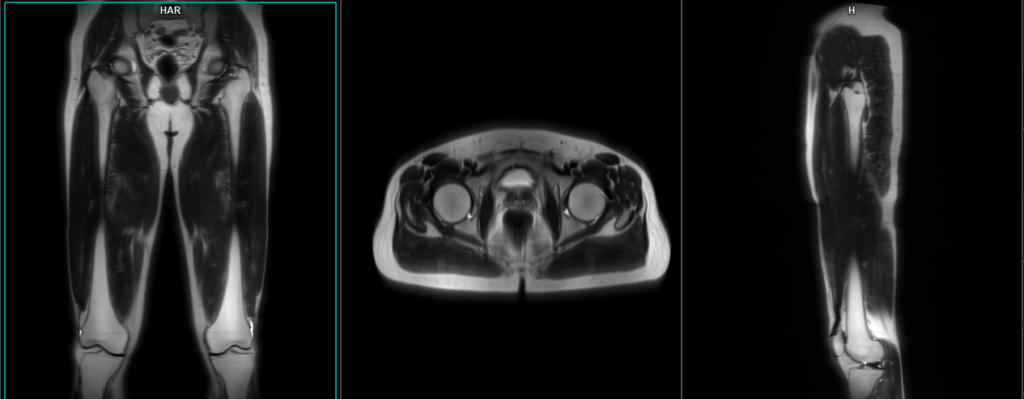 MRI thigh localiser
