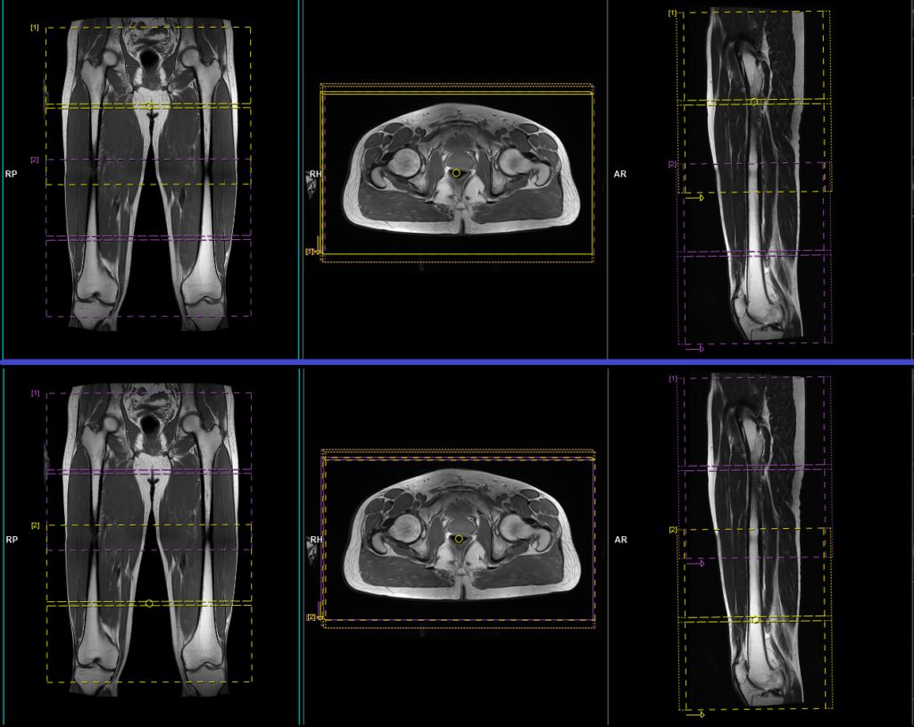 MRI thigh planning and protocol of axial scans