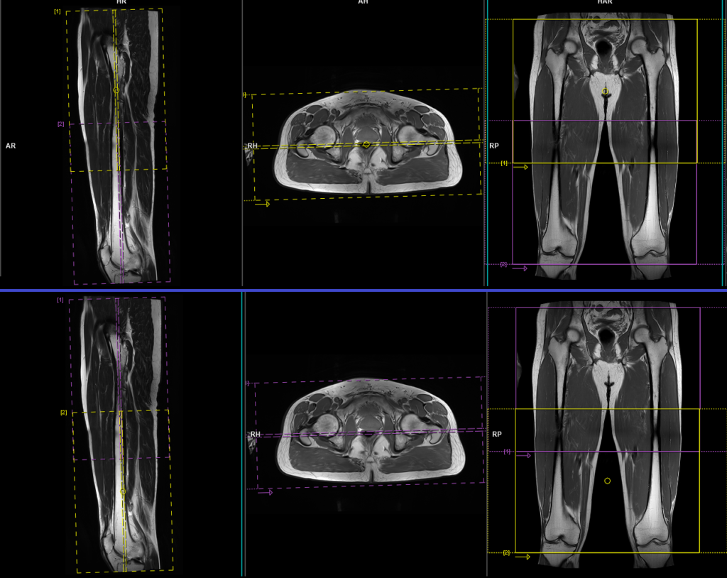 MRI thigh 2 station planning and protocol of coronal scans