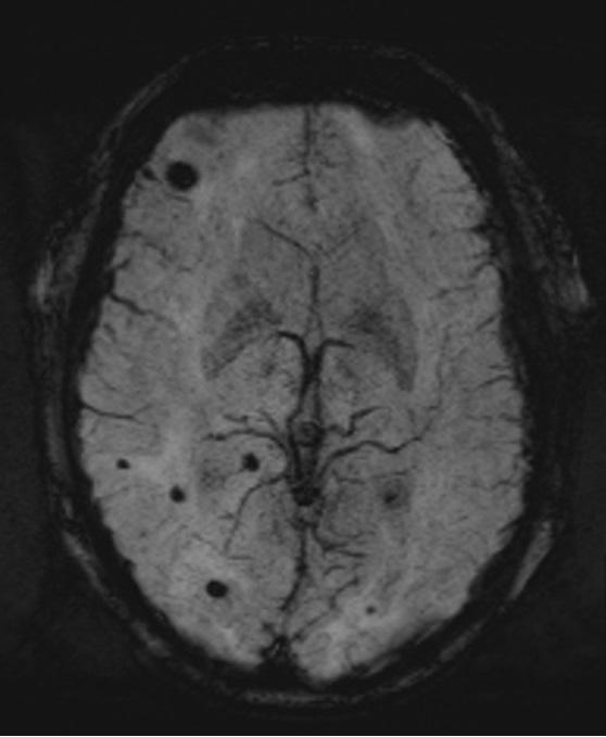 SWI mri microbleed appearance