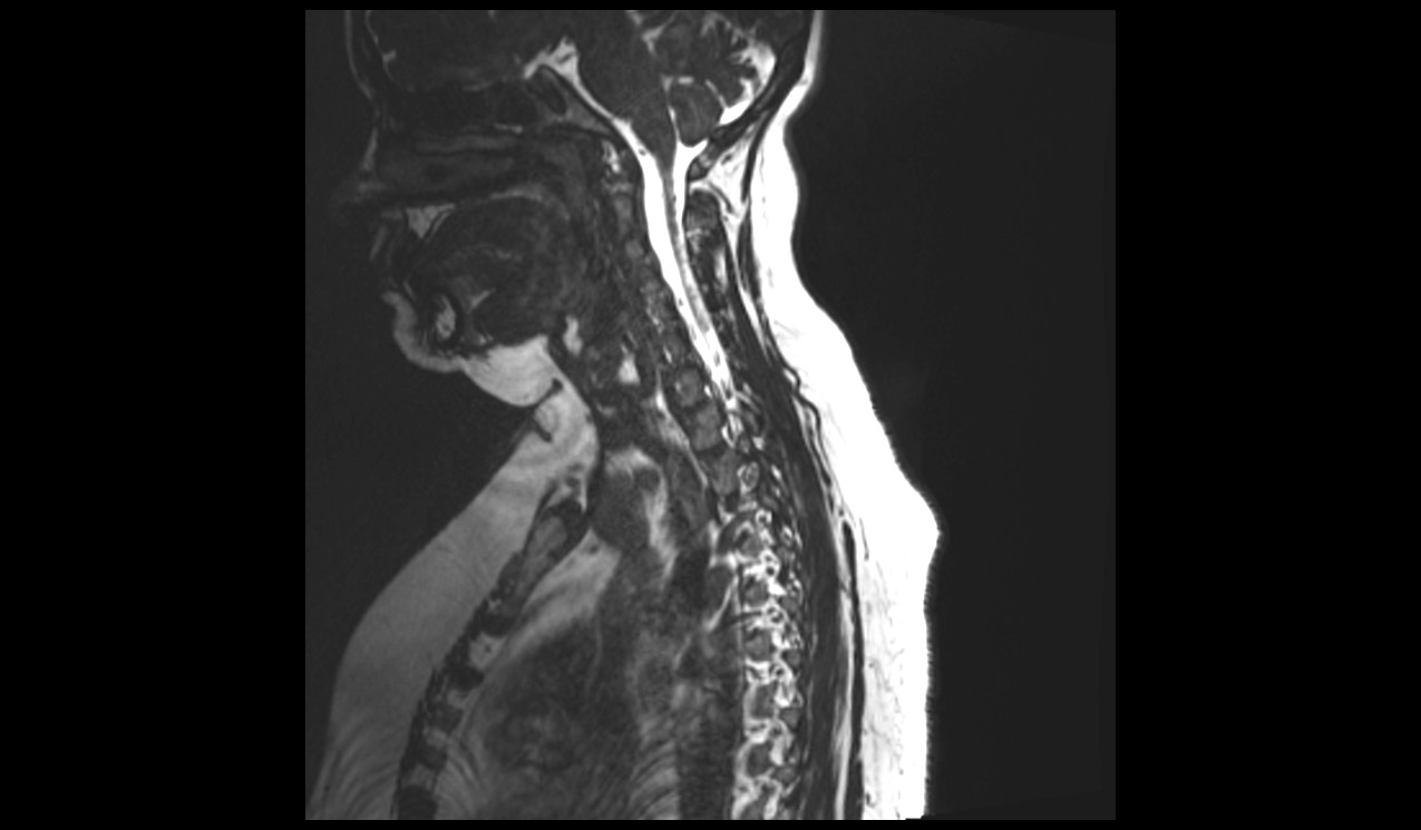 Sagittal CISS 3D sequence used in cervicothoracic spine imaging 1