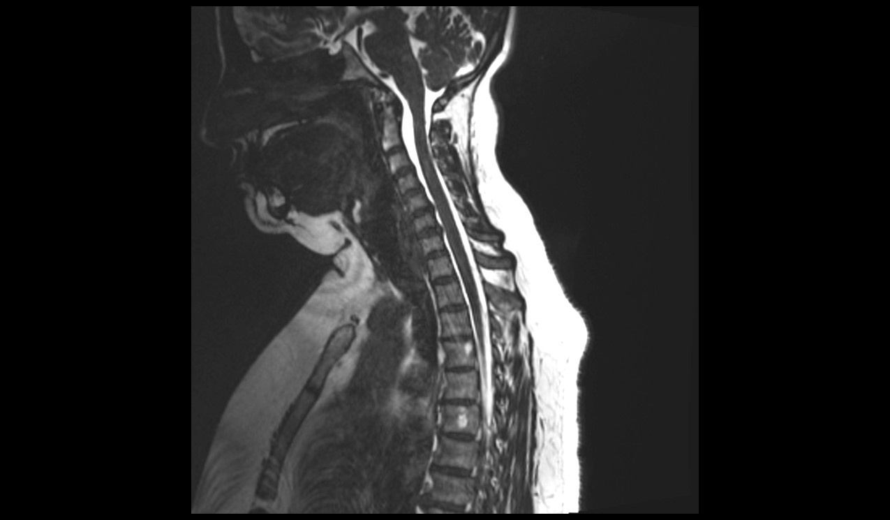 Sagittal CISS 3D sequence used in cervicothoracic spine imaging 2