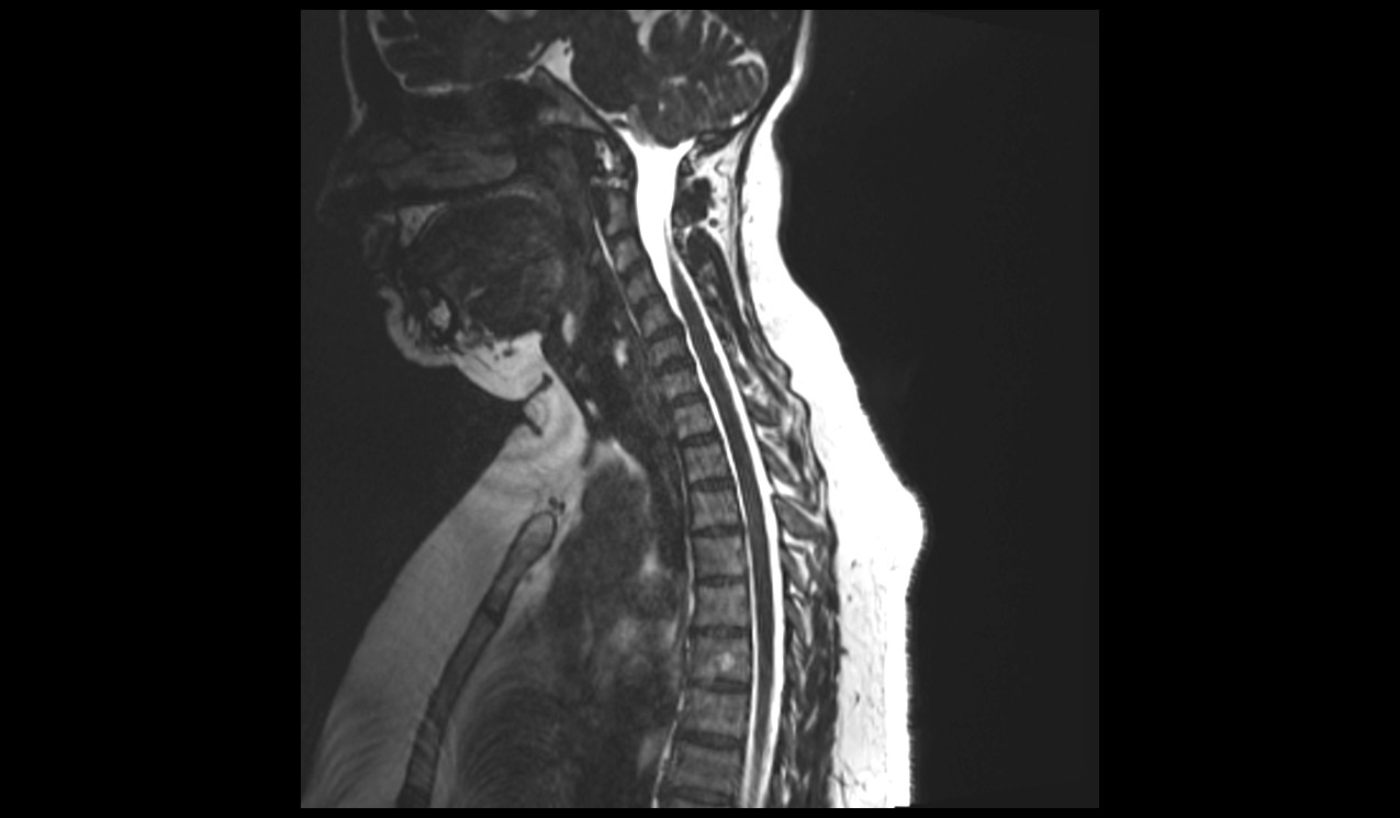 Sagittal CISS 3D sequence used in cervicothoracic spine imaging 3