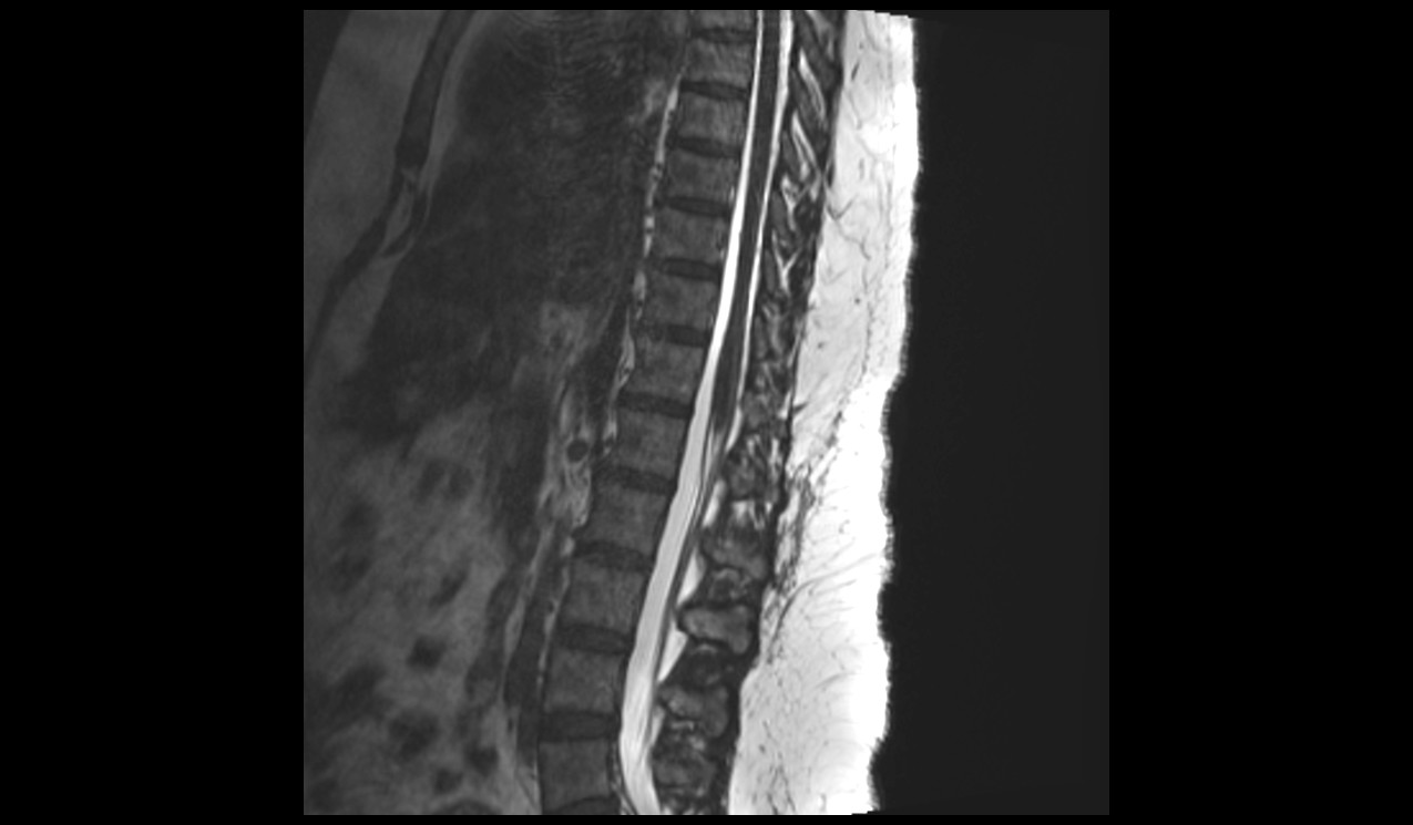 Sagittal CISS 3D sequence used in thoracolumbar spine imaging 2