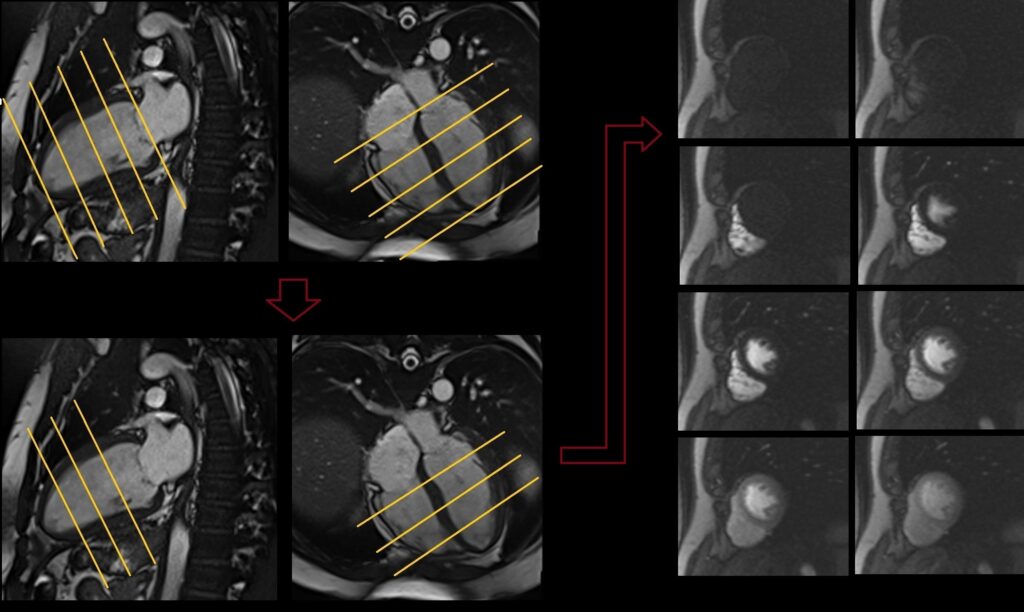 MRI Stress Perfusion Planning