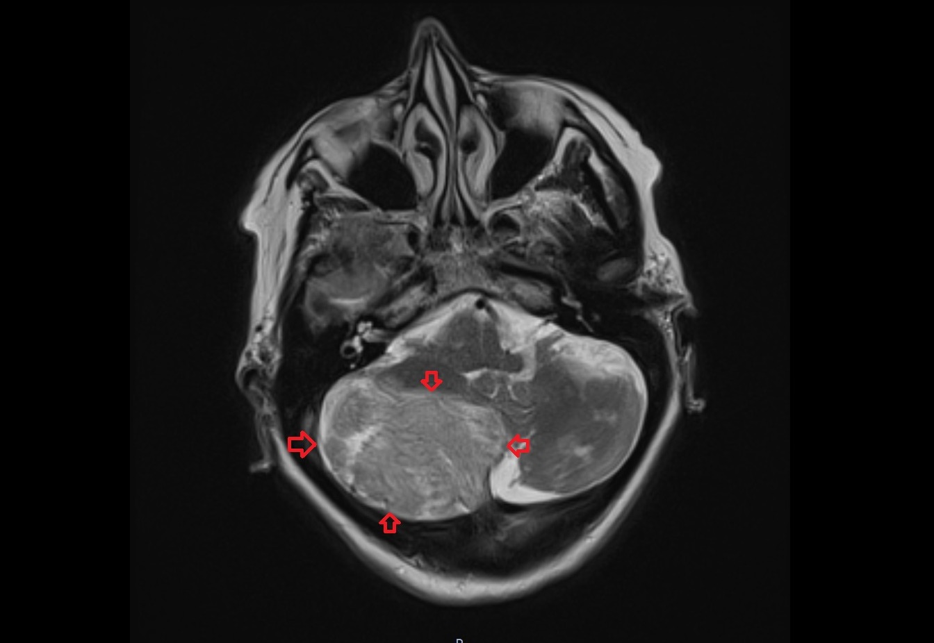 T2 axial image shows Dysplastic cerebellar gangliocytoma (Lhermitte-Duclos disease)