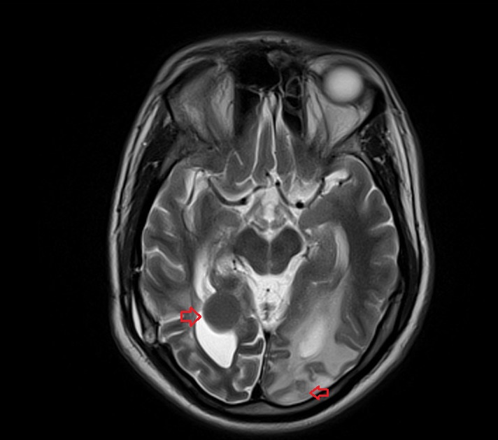 T2 axial image shows Intracranial tuberculoma