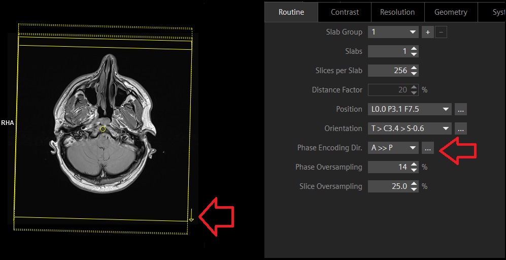 The image demonstrates the anterior to posterior phase encoding direction utilized in brain imaging.