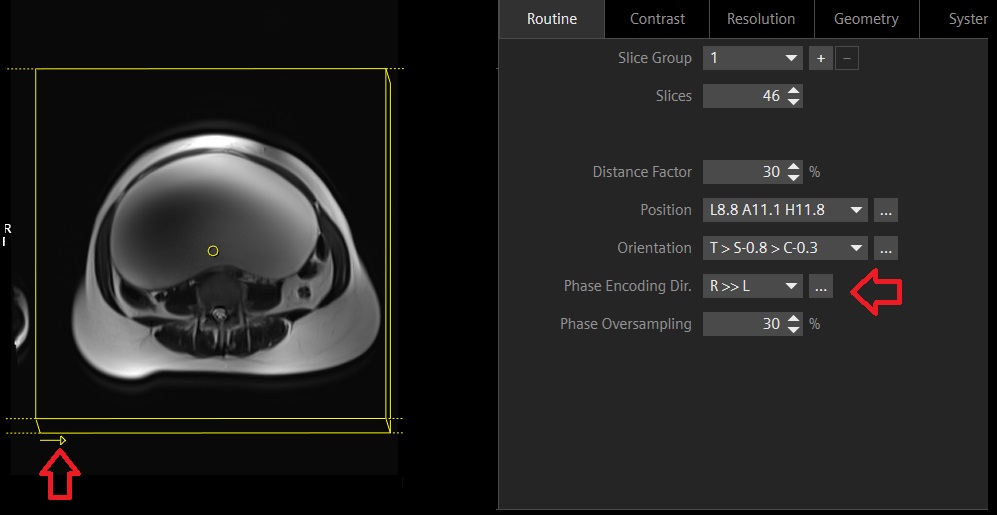 The image demonstrates the right to left phase encoding direction used in abdomen imaging.