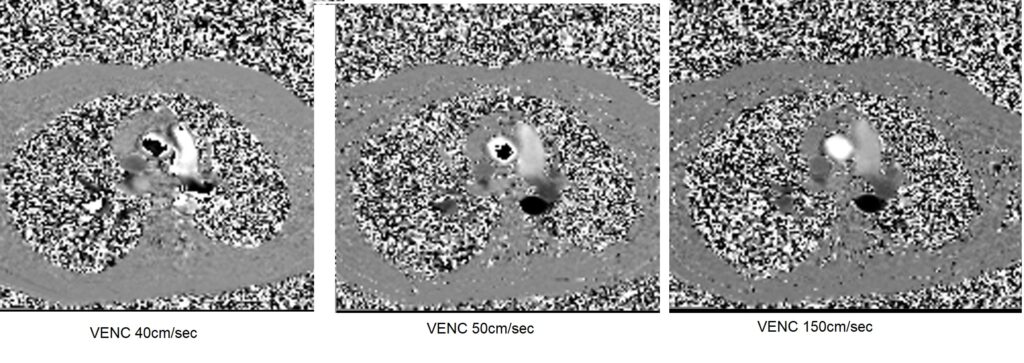 VENC scout of aorta