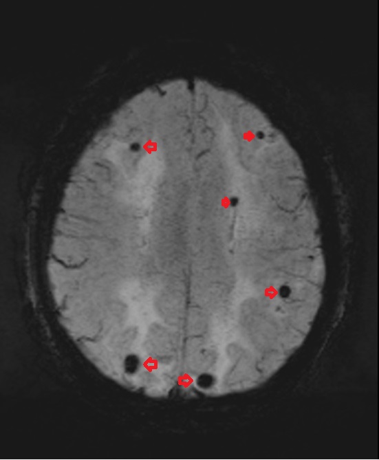 microbleed appearance in SWI mri