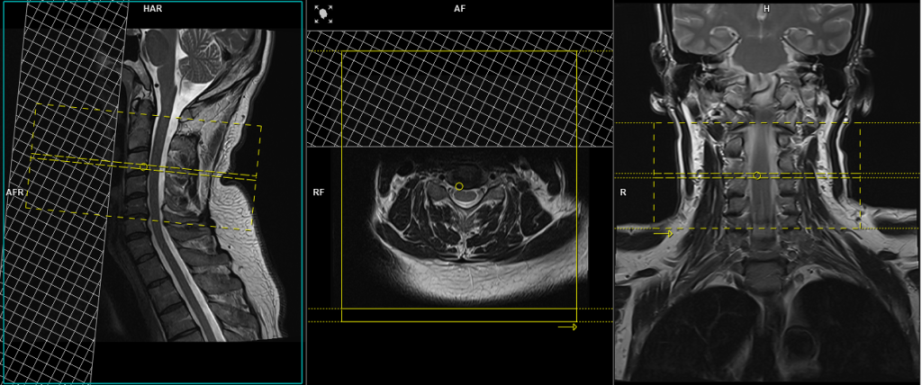 mri C spine CSF leak protocol axial T2 planning and protocol image