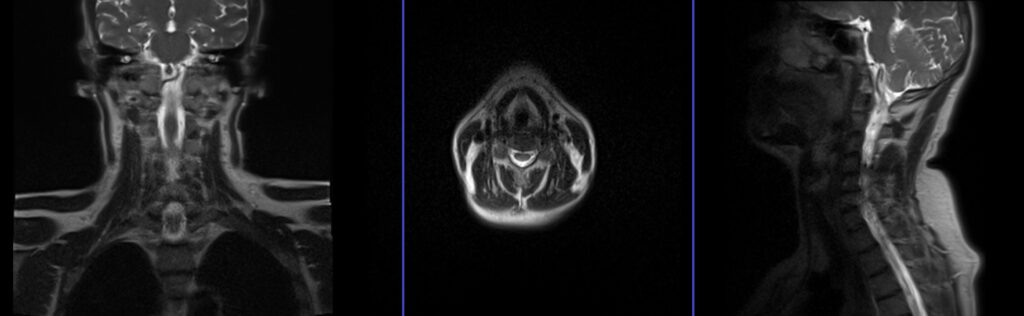 mri C spine CSF leak protocol localiser image image