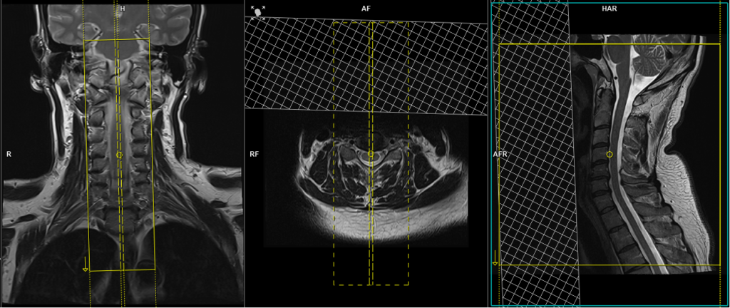 mri C spine CSF leak protocol sagittal T2 planning and protocol image