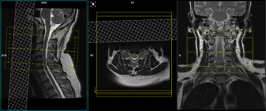 mri Cervical Spine CSF leak protocol axial T2 SPACE 3D planning and protocol image