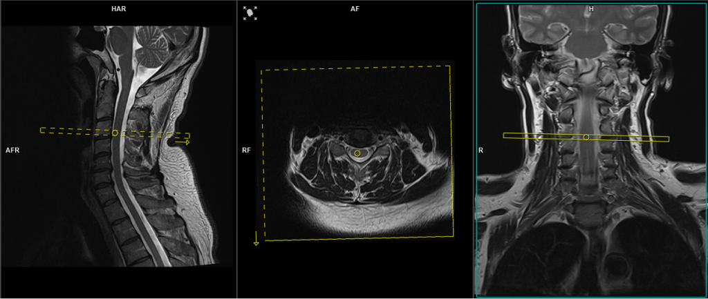 mri spine axial CSF Flow protocol and planning for C Spine CSF leak
