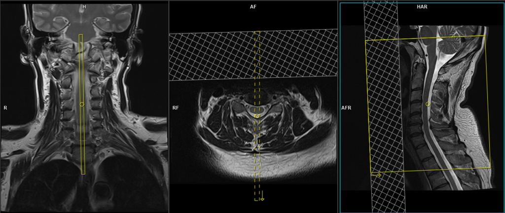 mri spine sagittal CSF Flow protocol and planning for C Spine CSF leak