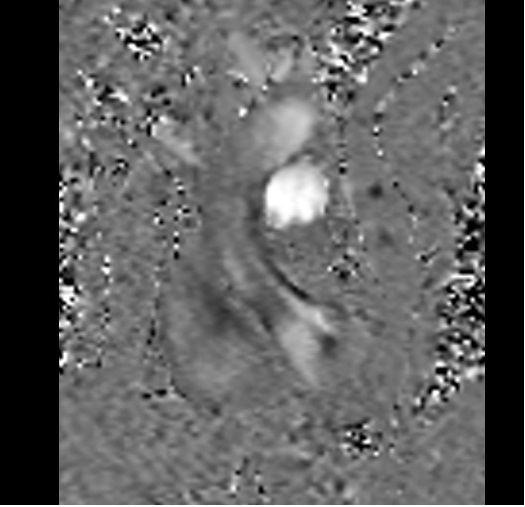 pulmonary artery flow flow is measured with a VENC of 110
