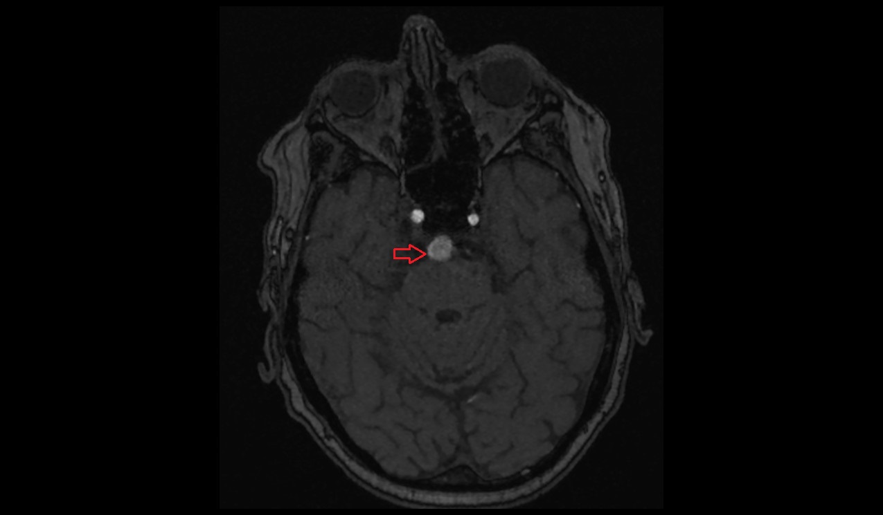 saccular aneurysms MRI axial TOF
