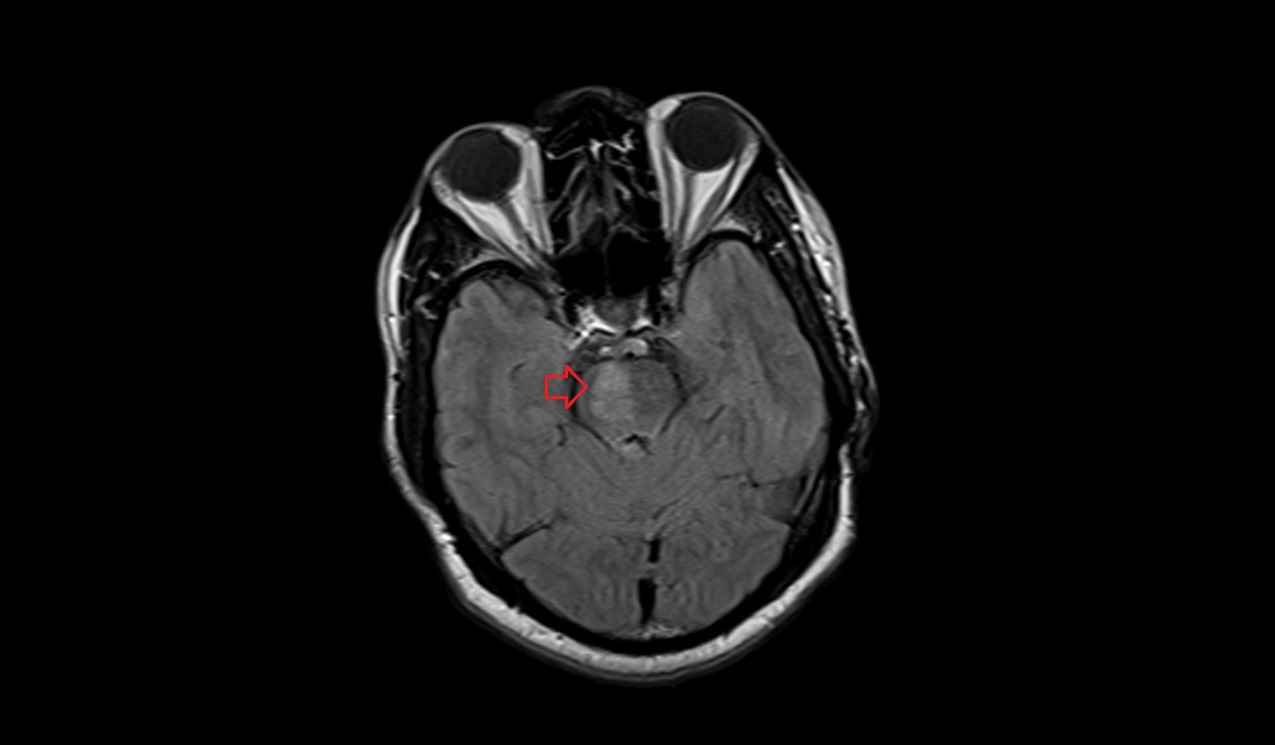 FLAIR axial images shows Acute pontine infarct
