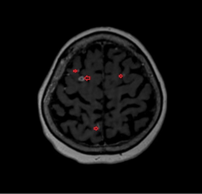 Brain Tuberculoma MRI