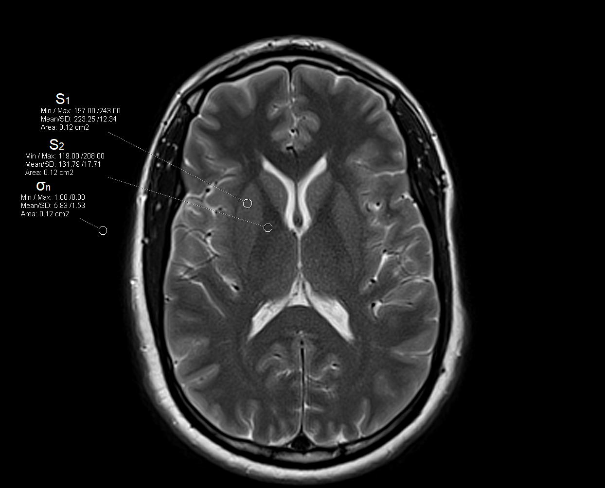 Contrast-to-Noise Ratio (CNR) in MRI and it's calculation