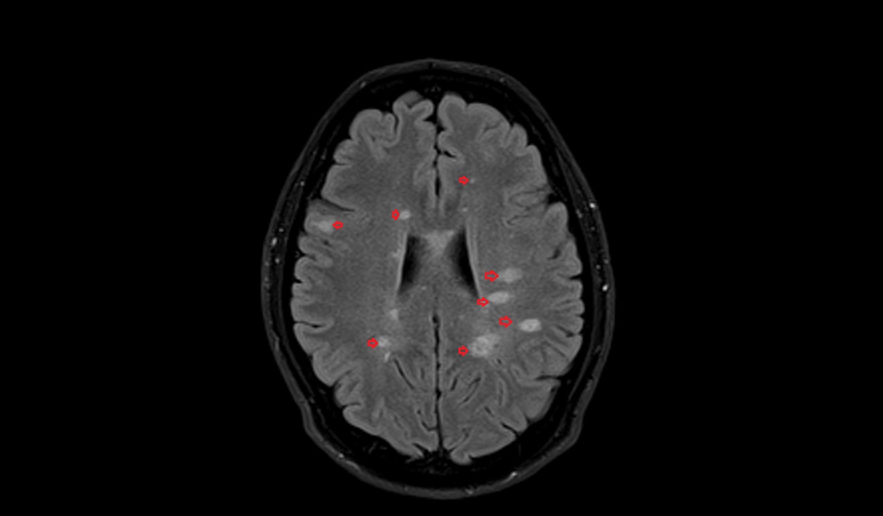 Multiple Sclerosis (MS) MRI FLAIR
